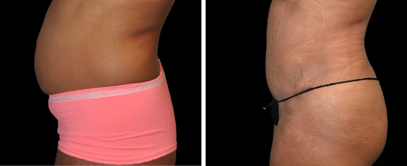 liposuction case 11-11