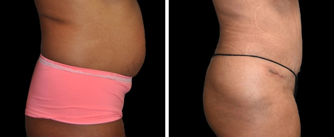 liposuction case 11-12
