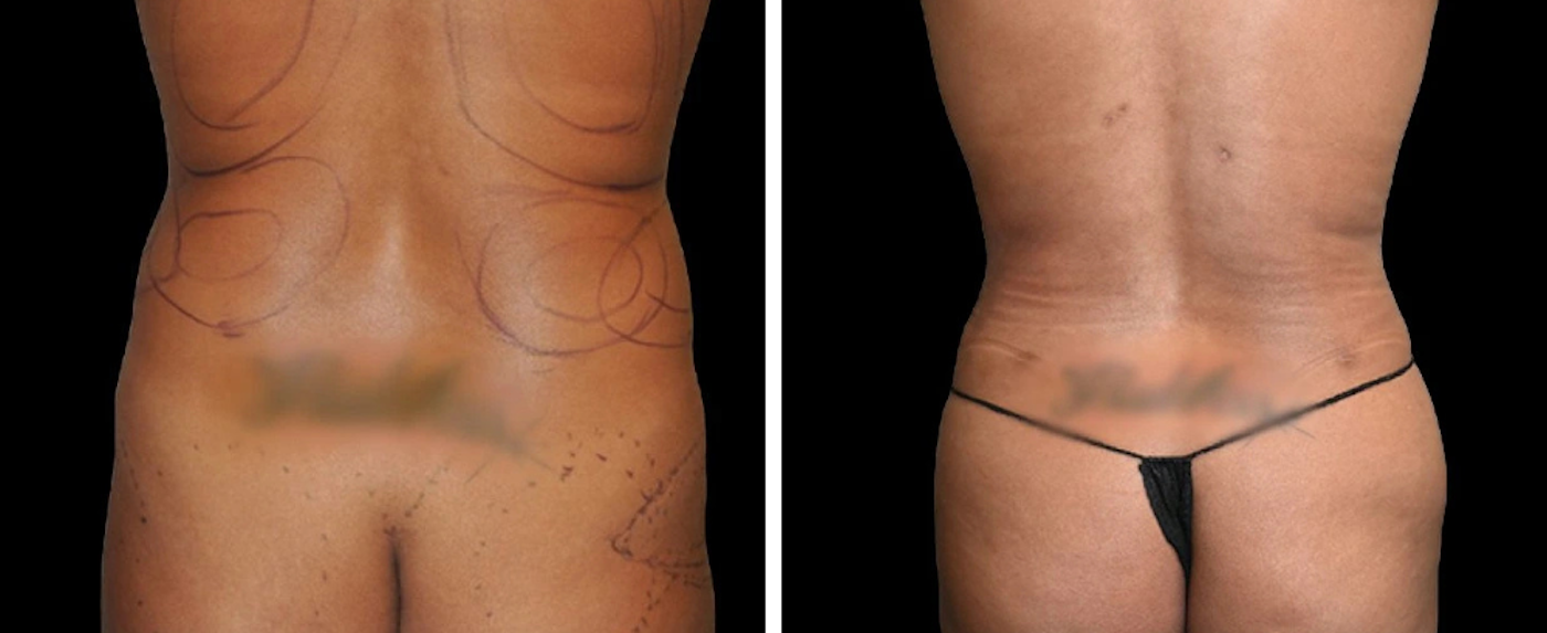 liposuction case 11-13