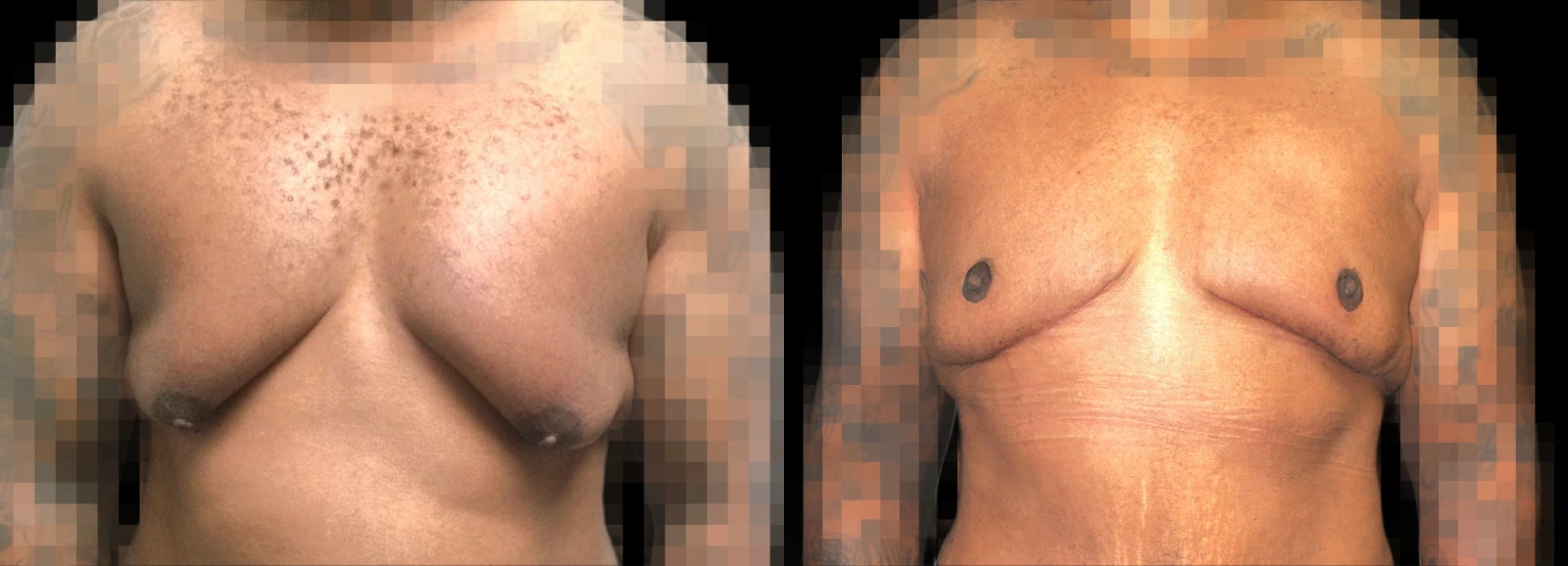 Before and after breast augmentation results with pixelated privacy protection