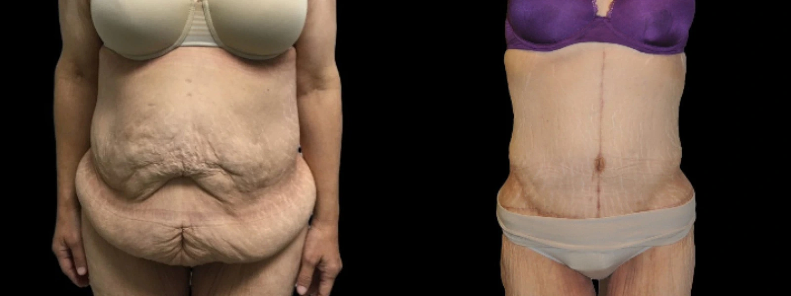 Front view before and after body contouring showing reduced abdominal and flanks laxity