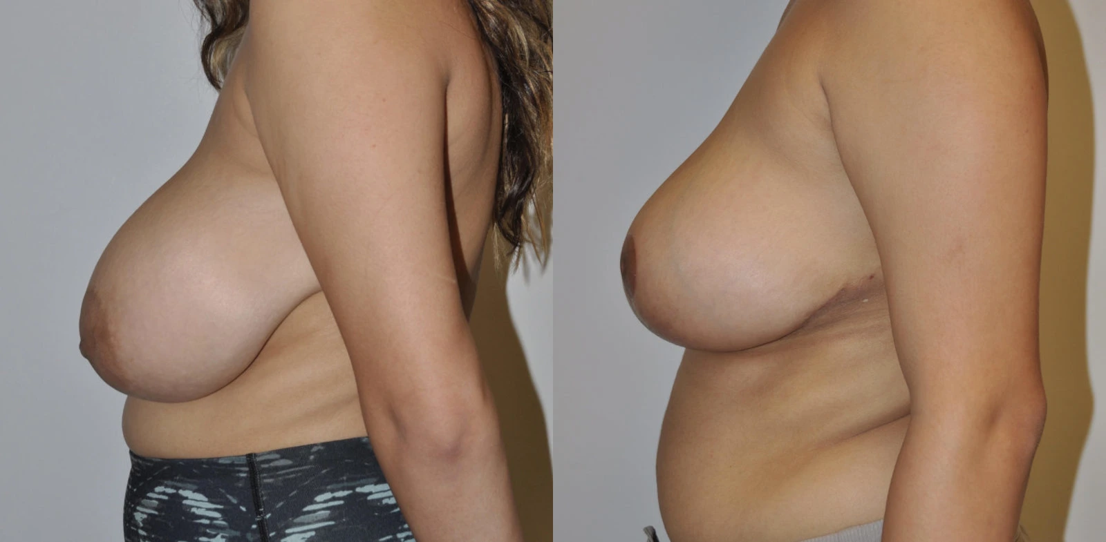 Before and after side view of breast augmentation results