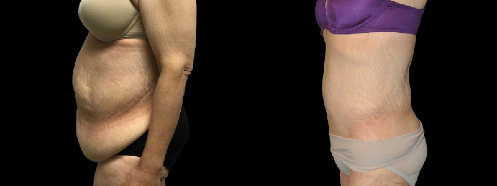 Side profile before and after body contouring showing improved waist definition and skin firmness