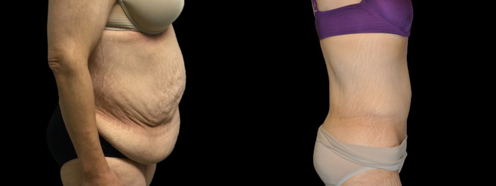 Side profile before and after body contouring showing reduced midsection fullness