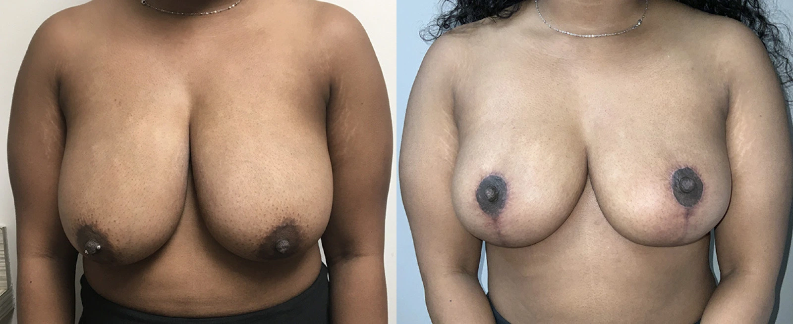 Before and after frontal comparison of breast augmentation results