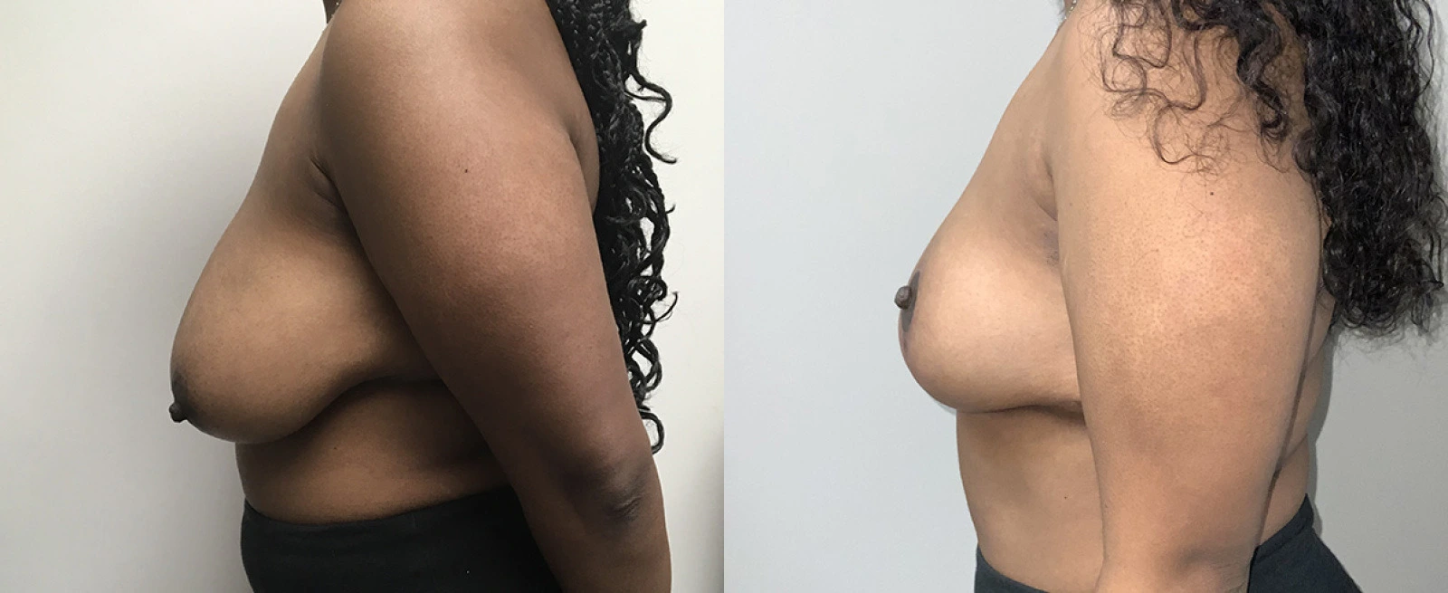 Before and after side profile comparison of breast augmentation results