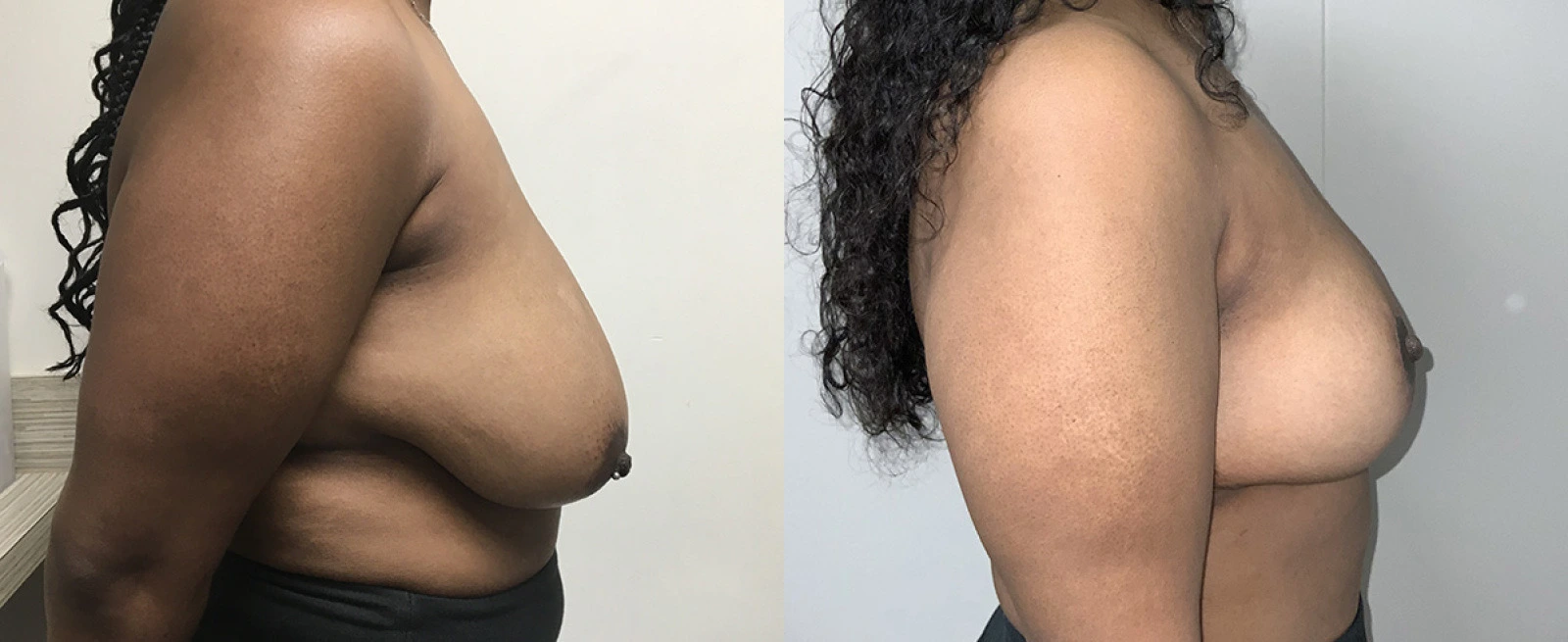 Before and after breast augmentation, side view comparison