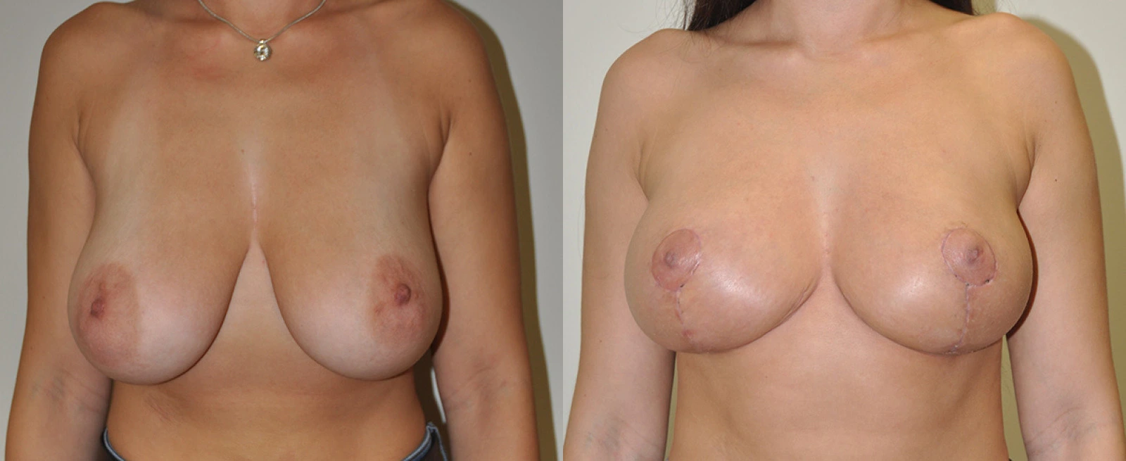 Before and after frontal comparison of breast augmentation results