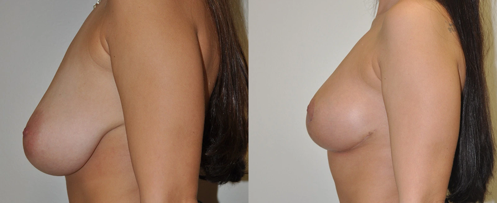 Before and after side profile comparison of breast augmentation results