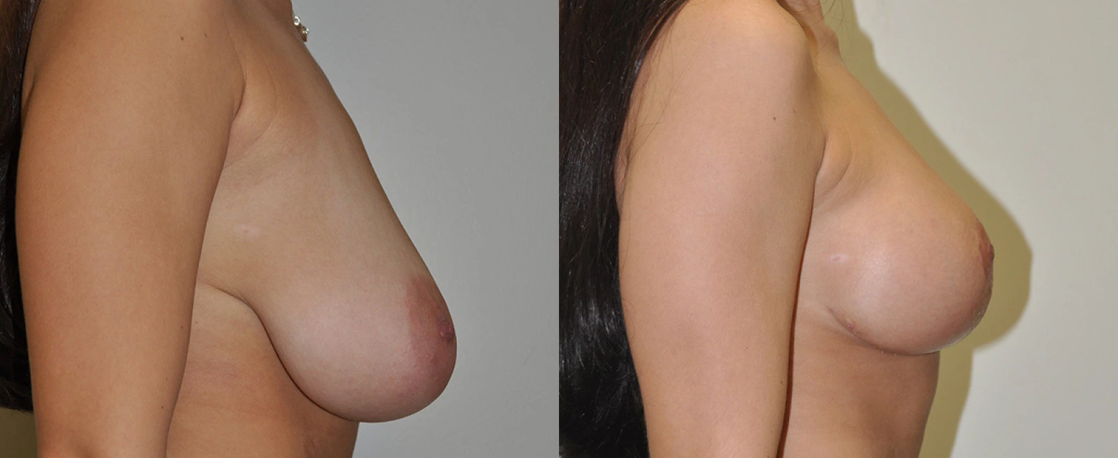 Before and after side profile comparison of breast augmentation results