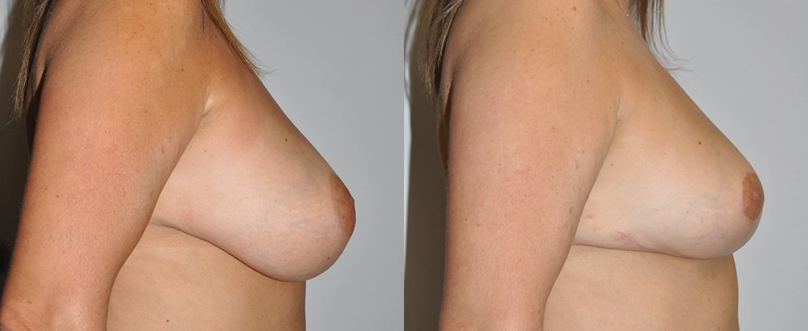 Before and after side profile comparison of breast augmentation results