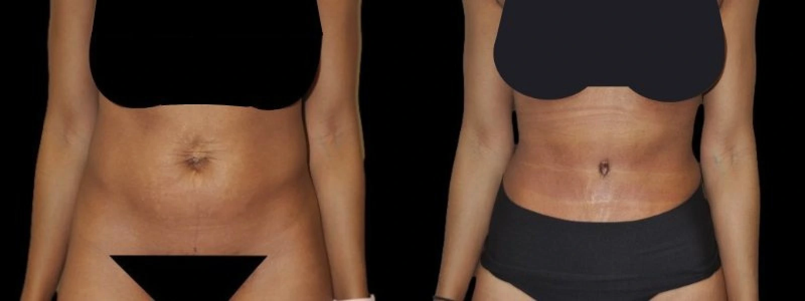Front-facing torso before and after body contouring showing improved abdominal definition and reduced midsection