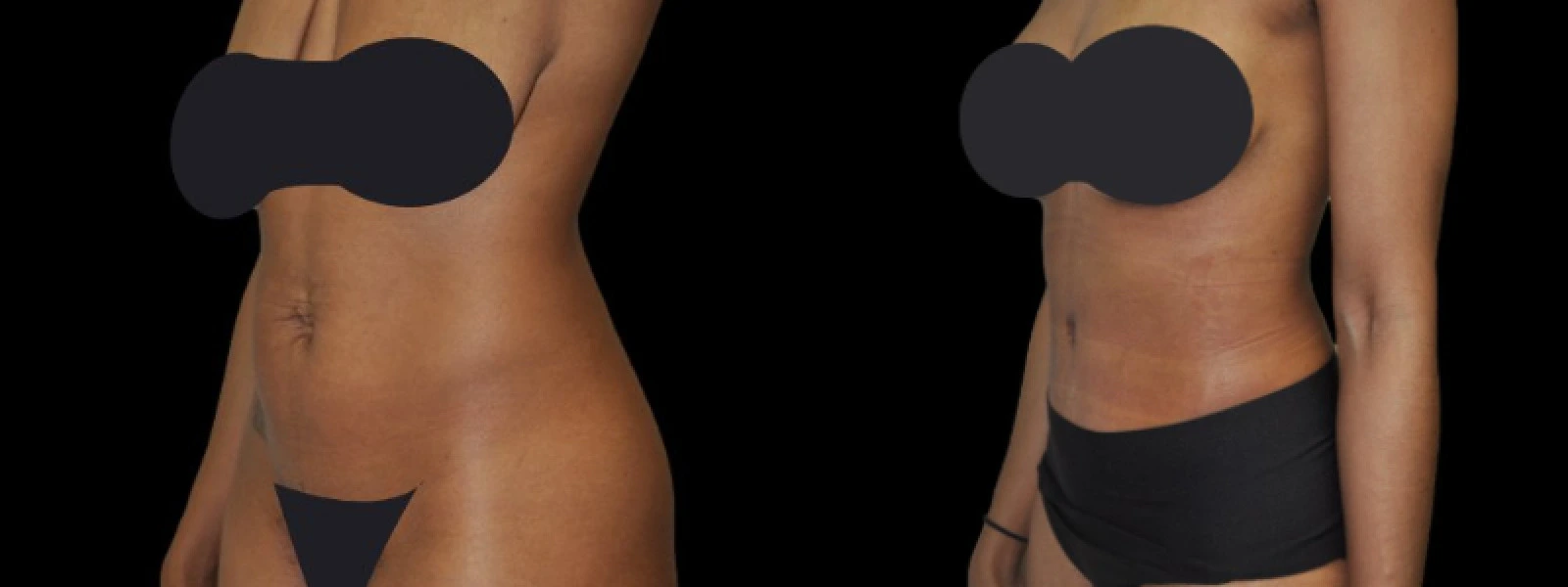 Front and back view of torso showing body contouring results with reduced flanks and improved waistline