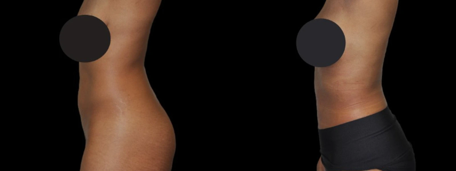 Side-by-side profile view of torso showing body contouring results with improved abdominal contour