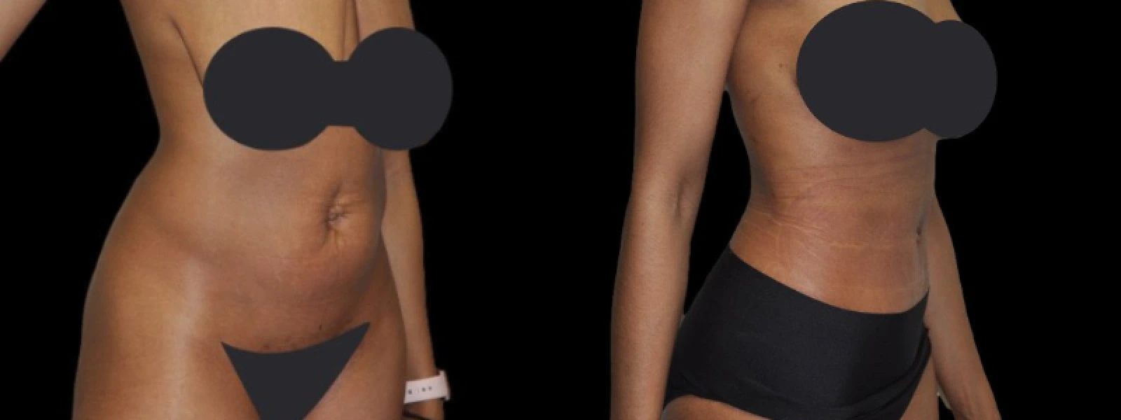 Front and back view of torso showing body contouring results with reduced midsection and improved definition
