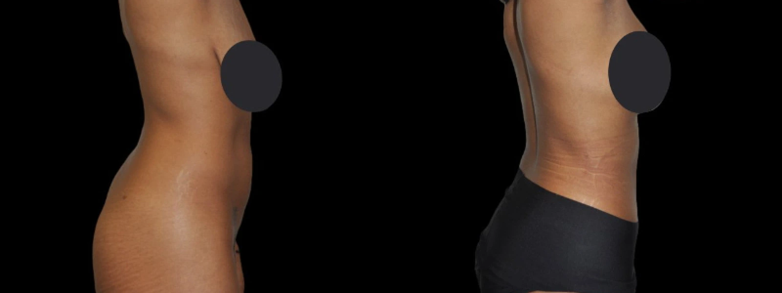 Before and after thigh contouring, side view showing improved leg contour and definition