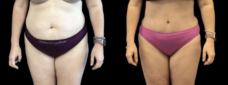 Before and after comparison: left shows abdominal laxity and fullness, right shows toned flat abdomen