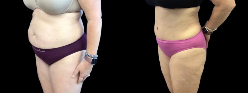 Before and after comparison: left shows abdominal fullness and excess skin, right shows defined waistline