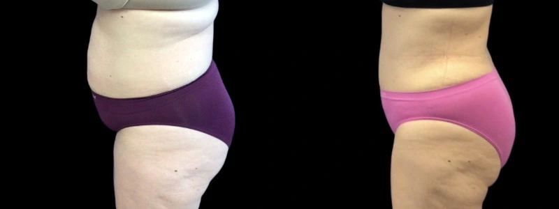 Before and after comparison: left shows abdominal bulge and thigh skin laxity, right shows contoured abdomen and thighs