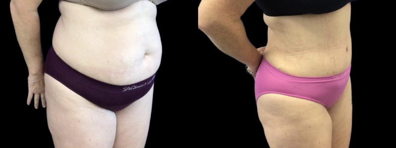 Before and after comparison: left shows abdominal fullness and skin laxity, right shows flattened abdomen