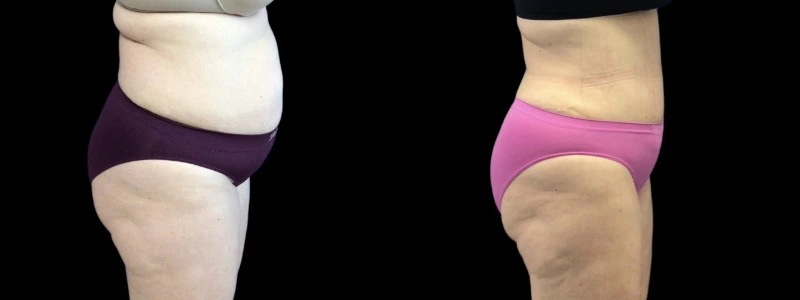 Before and after comparison: left shows abdomen and thighs with excess skin, right shows toned abdomen and thighs