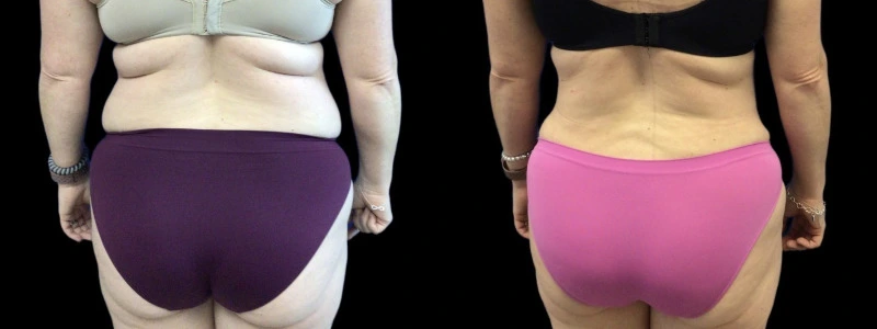 Rear view of lower back and buttocks showing body contouring results with improved contour and reduced back fat