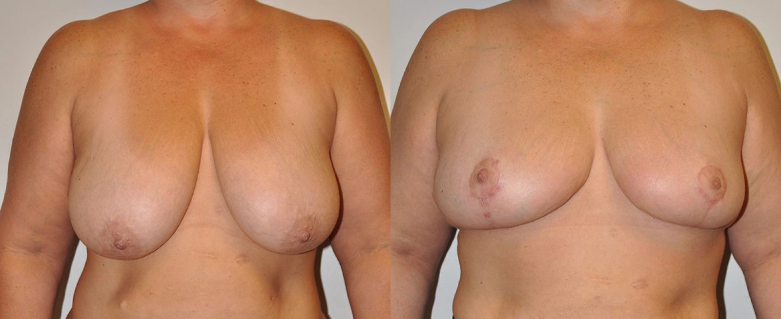 Before and after frontal view of breast procedure results