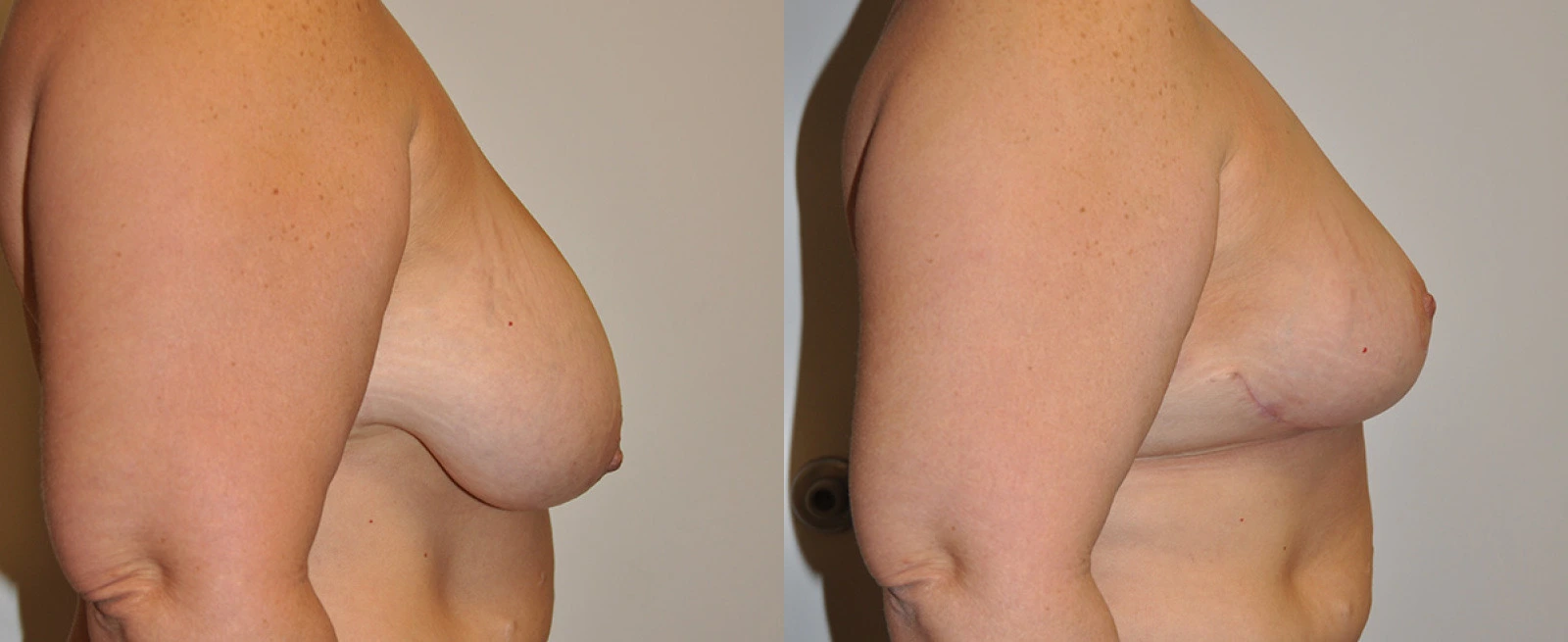 Before and after side profile view of breast procedure results