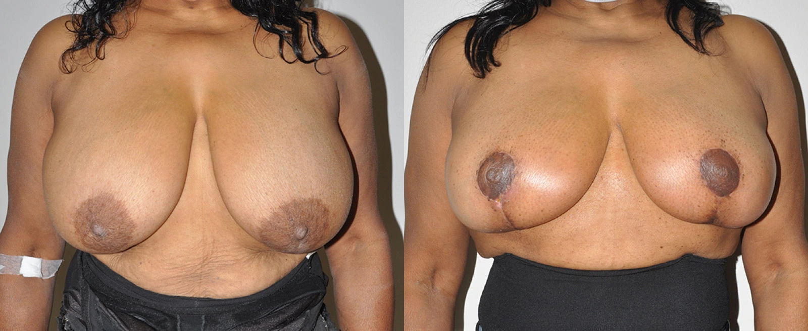 Before and after frontal view comparison of breast augmentation results