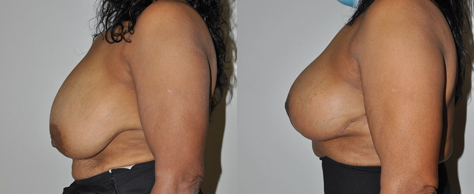 Before and after side profile comparison of breast augmentation results