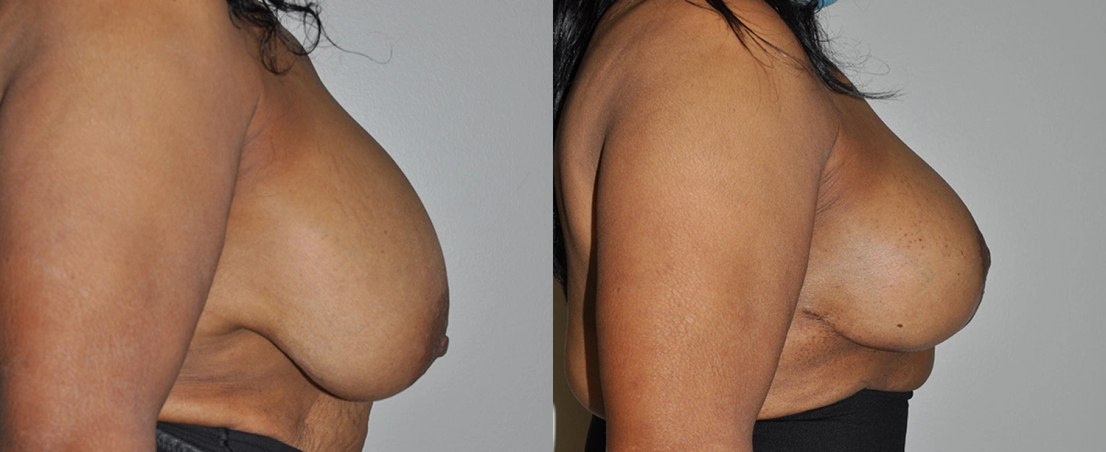 Before and after side profile view of breast procedure results