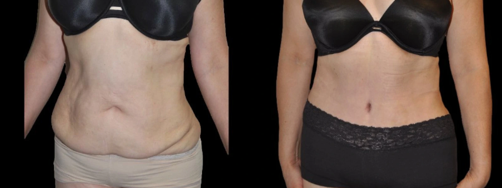 Before and after front torso views showing decreased abdominal skin laxity and improved muscle definition