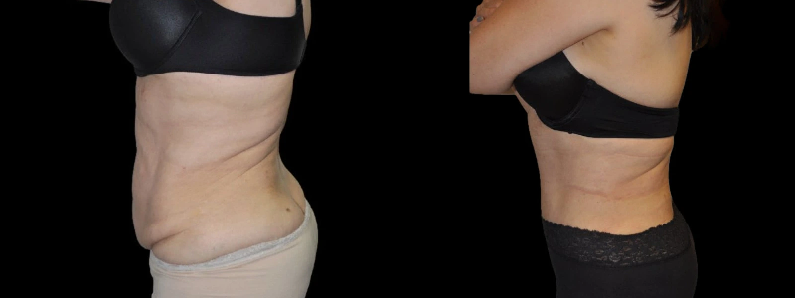 Before and after lateral views demonstrating flattened abdomen and enhanced waistline definition