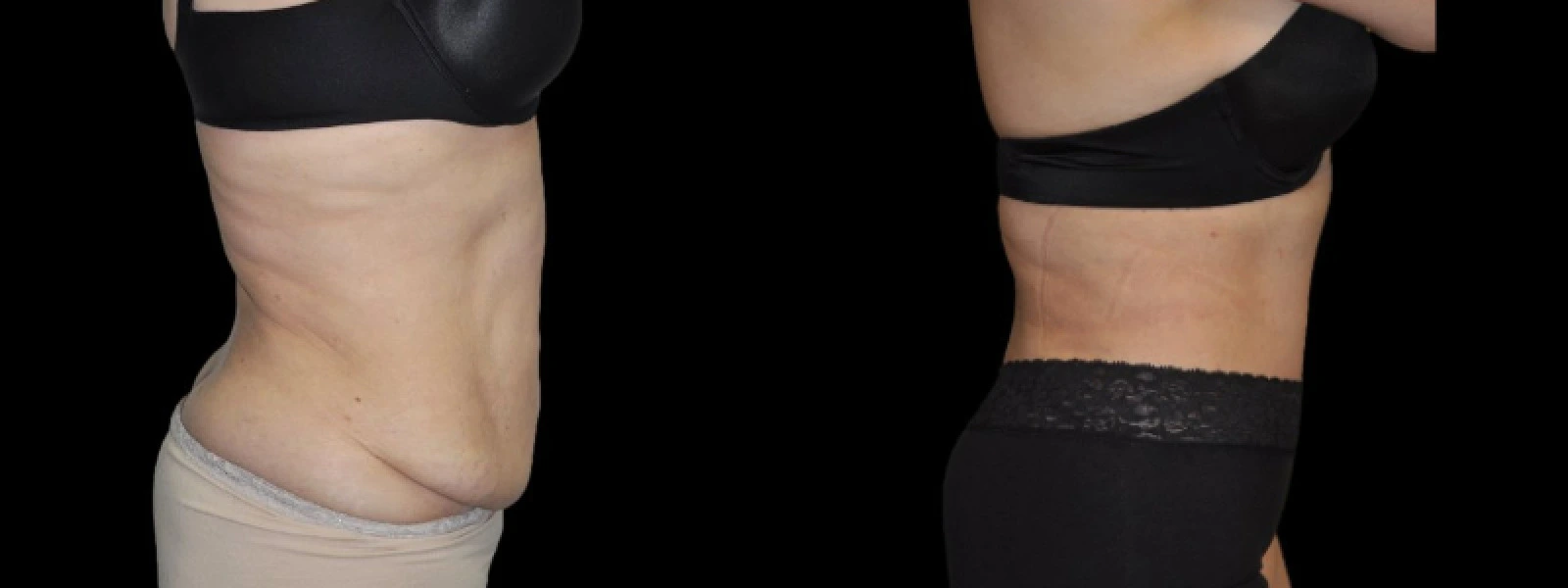 Before and after side views of torso showing reduced waist circumference and improved abdominal contours