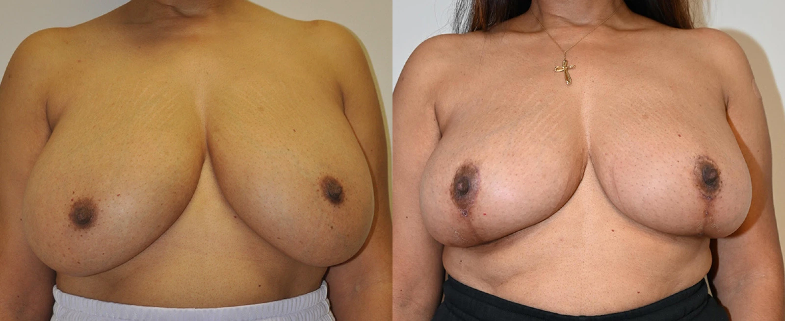 Before and after breast augmentation results showing frontal comparison