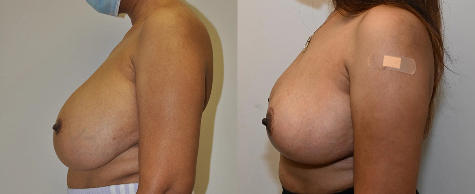 Before and after breast augmentation results showing side profile comparison