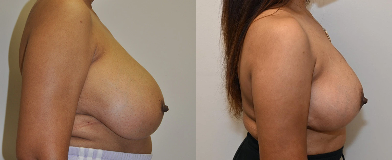 Before and after side profile comparison of breast augmentation results