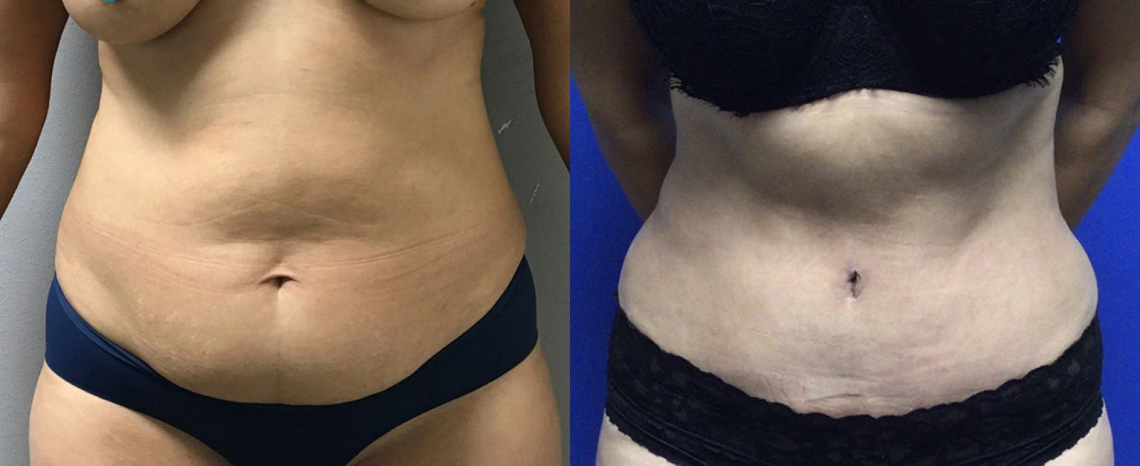 Before and after abdominal area displaying reduced sagging and enhanced body contour