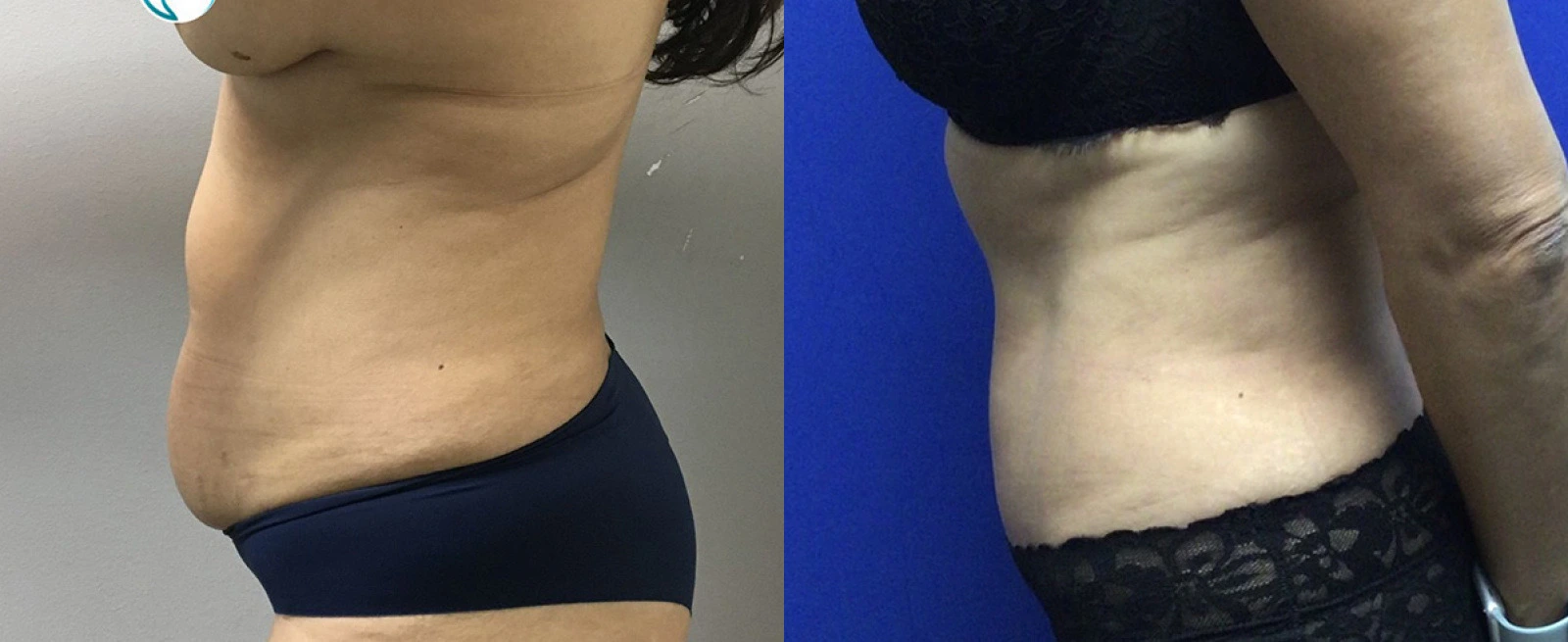 Side-by-side before and after of abdomen showing firmer appearance and improved skin tightness