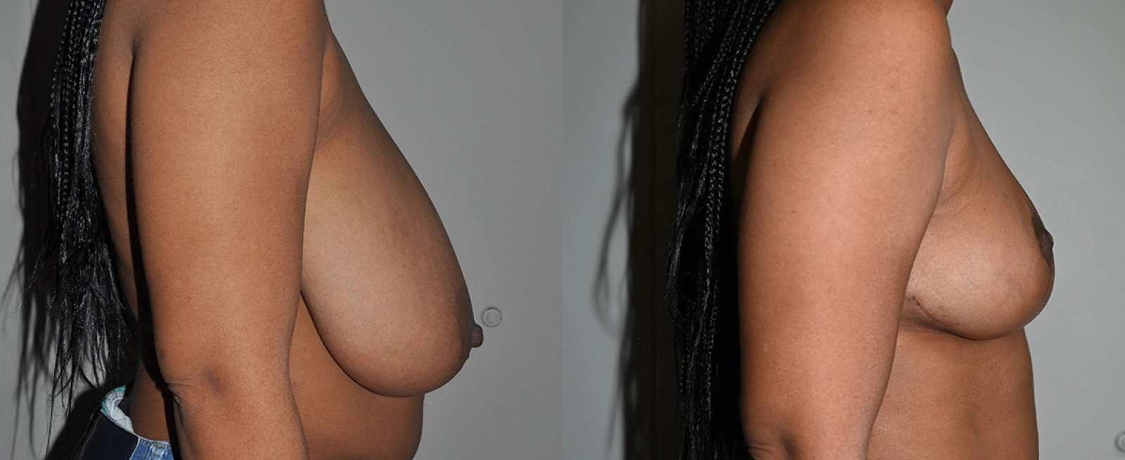 Before and after breast augmentation results showing side profile comparison