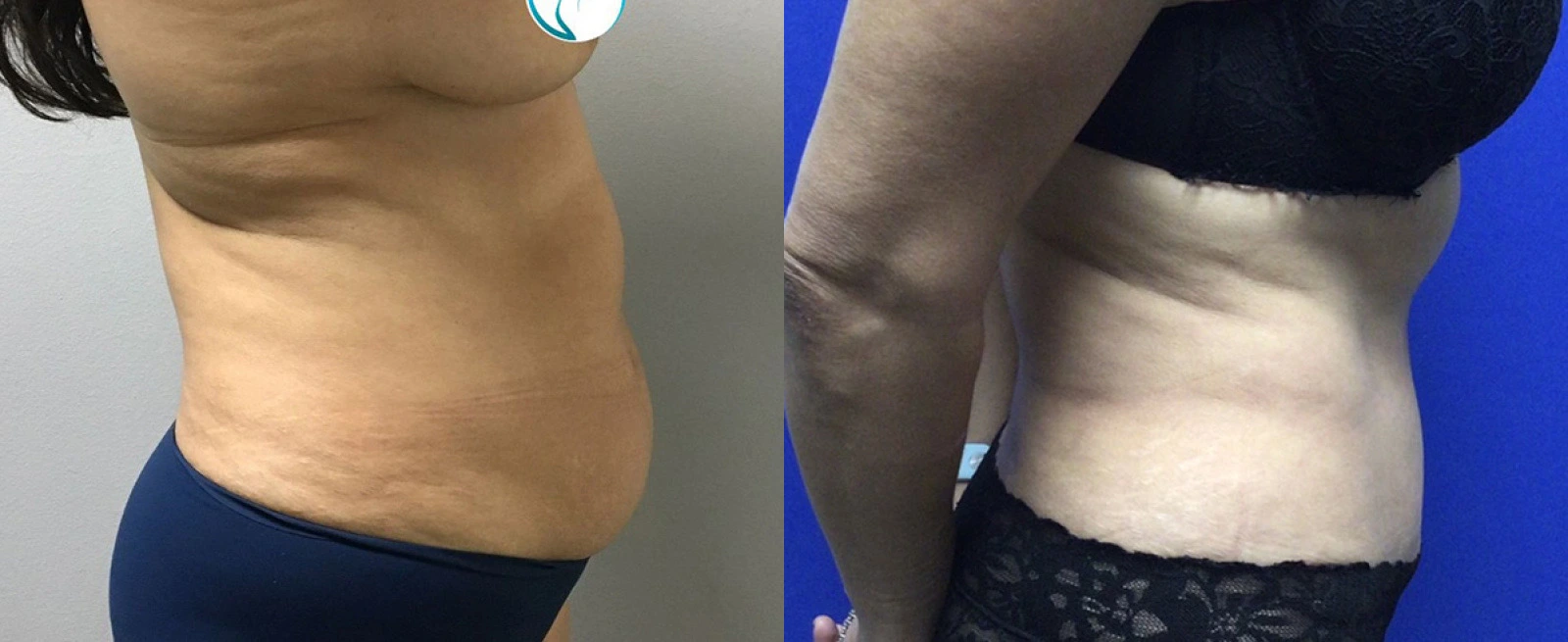 Before and after abdominal treatment with visible reduction in skin laxity and smoother contour