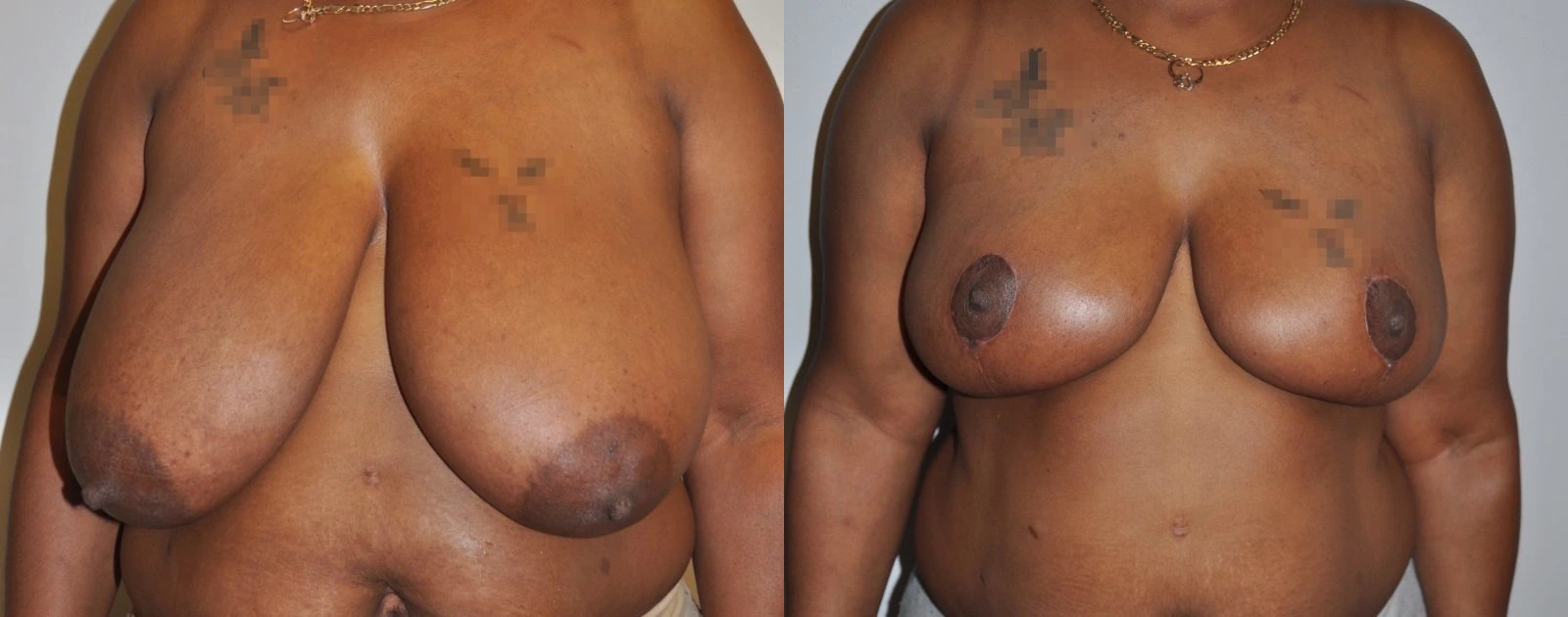 Before and after breast lift surgery, front view comparison