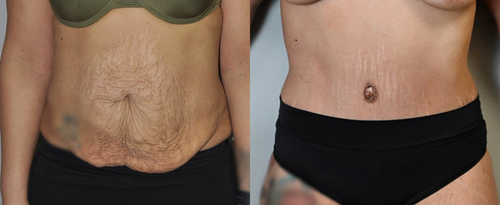 Front view of abdomen before and after body contouring procedure