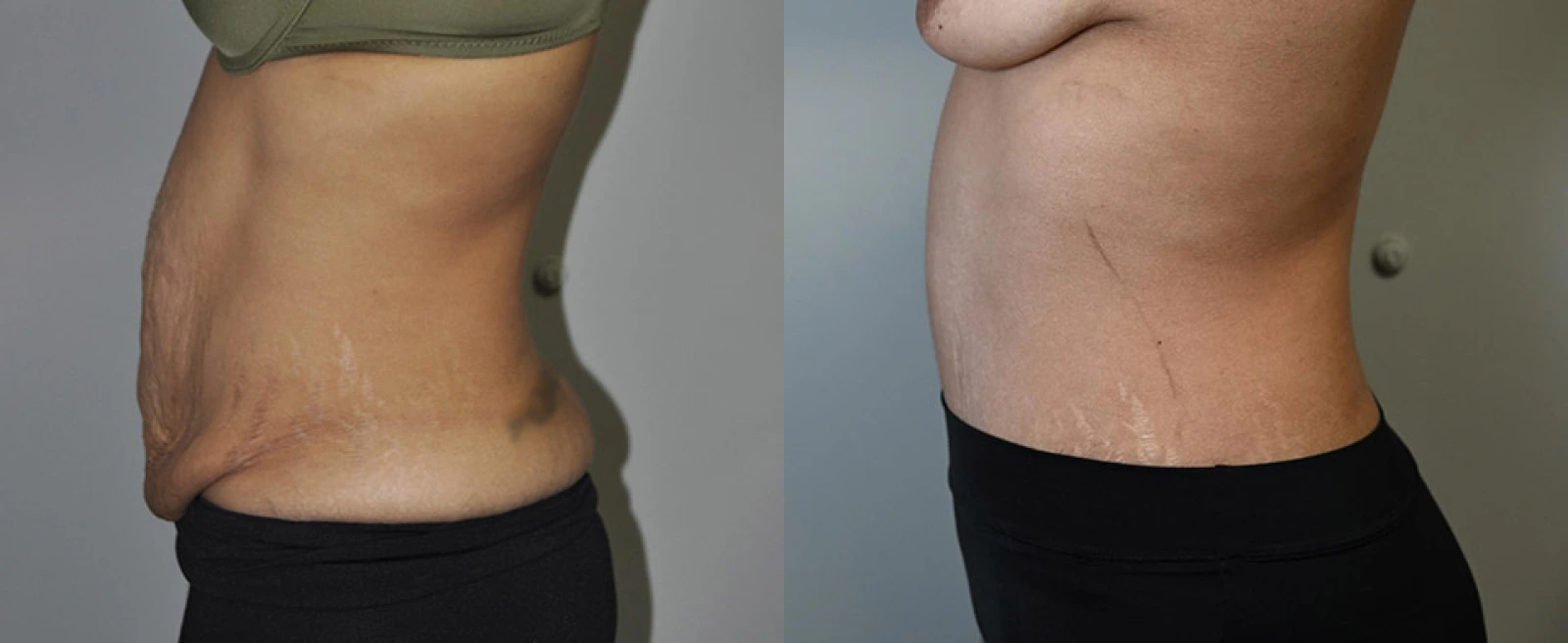 Left lateral view of abdomen before and after body contouring procedure