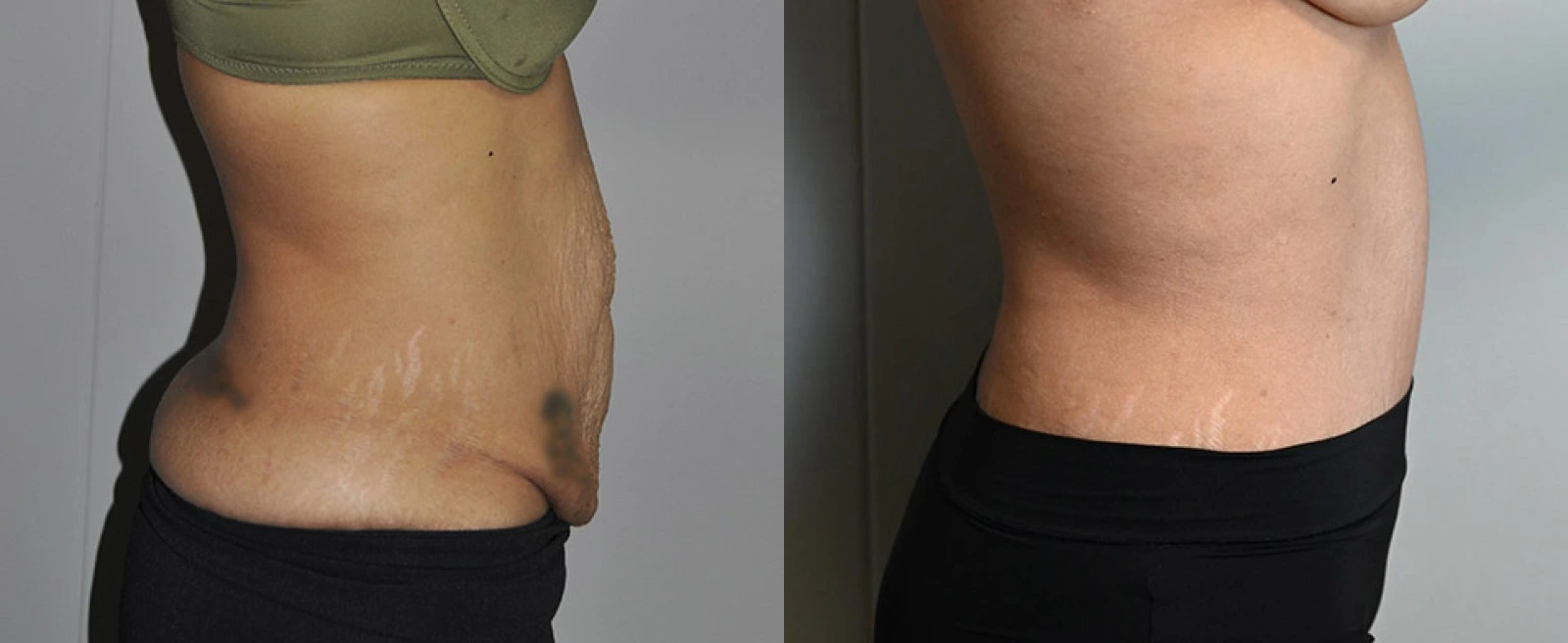 Left lateral view of abdomen before and after body contouring procedure