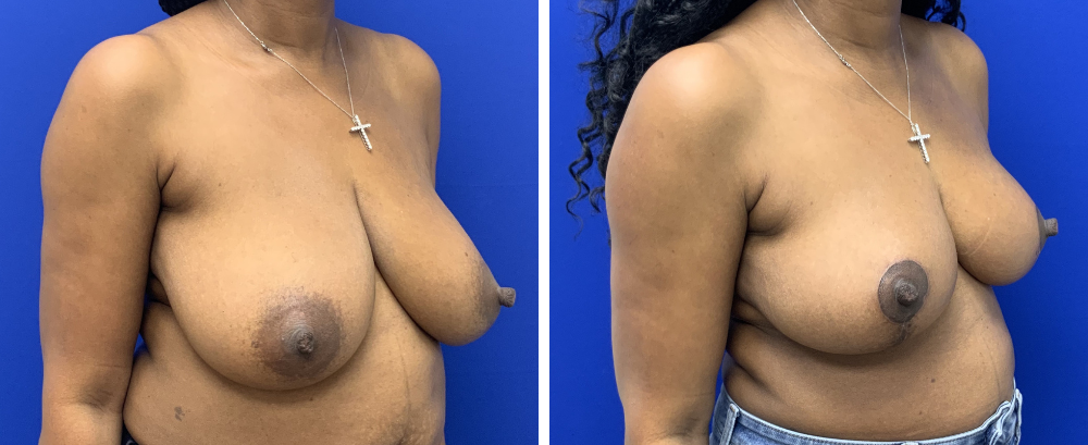 breast reduction case 21-2