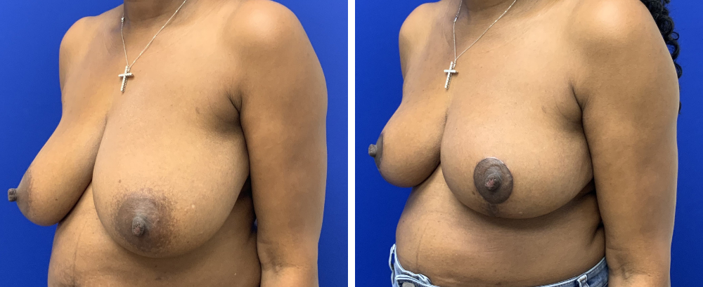 breast reduction case 21-3