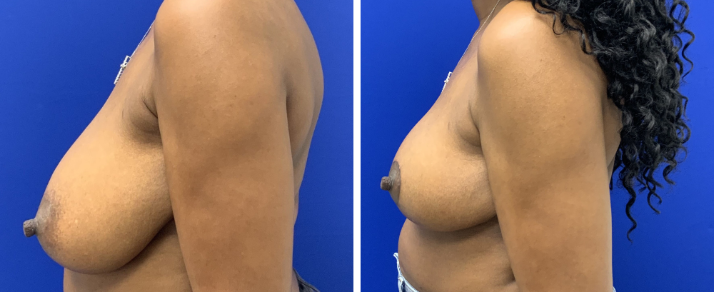 breast reduction case 21-4