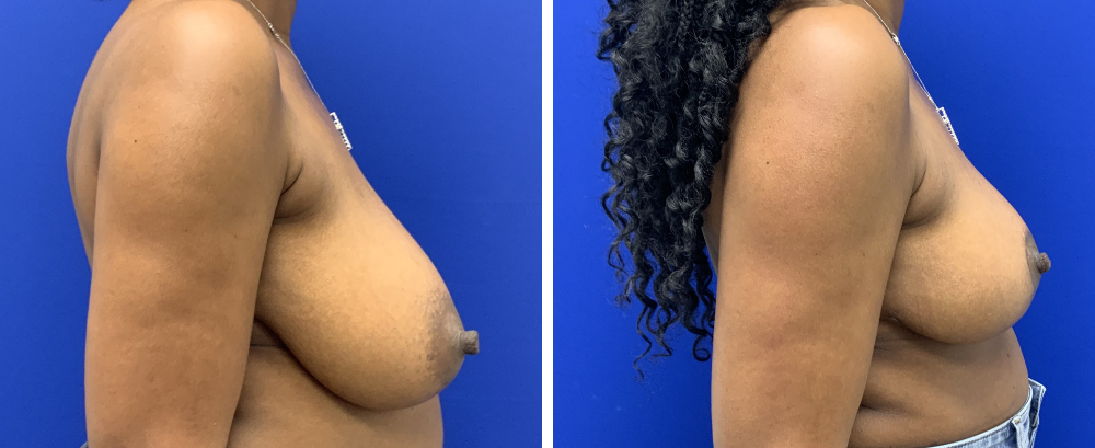 breast reduction case 21-5