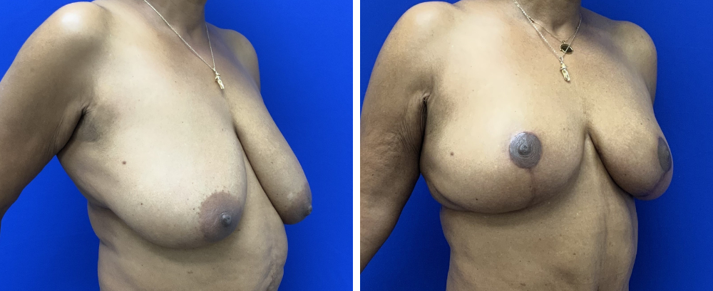 breast reduction case 22-2